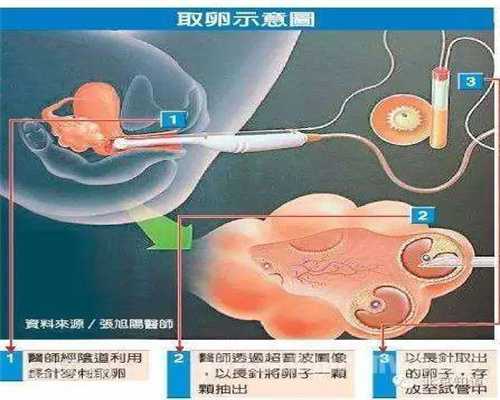 实拍女子捐卵过程图片：生娃可以治痛经，也可