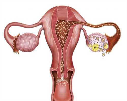 试管婴儿输卵管异常的原因是什么？