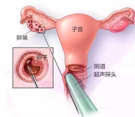 泰国试管代孕婴儿的利弊分析，泰国试管代孕婴儿卵巢早衰可以找广州爱心捐卵符号